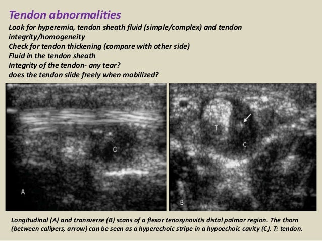 Presentation1.pptx, ultrasound of the hand and fingers.