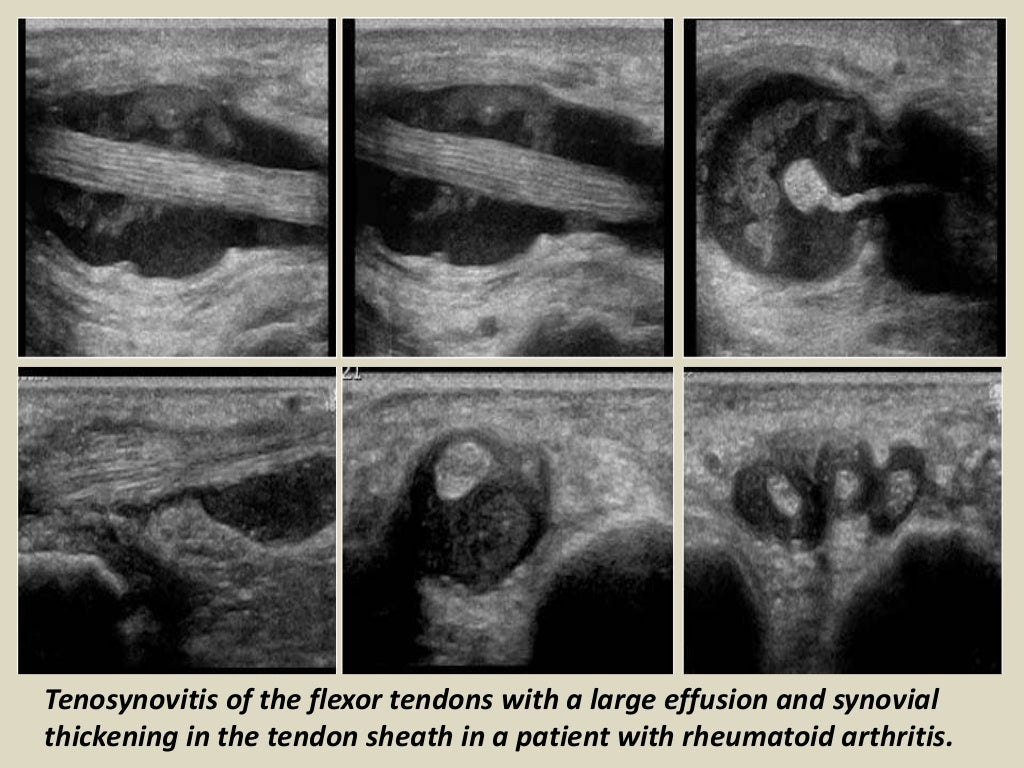 Presentation1.pptx, ultrasound of the hand and fingers.