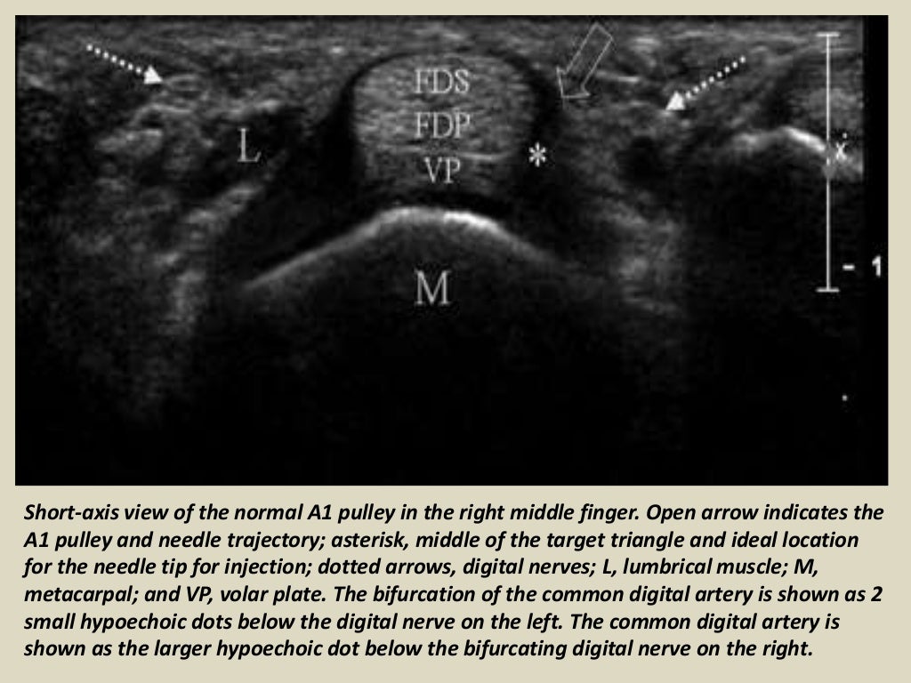 Presentation1.pptx, ultrasound of the hand and fingers.