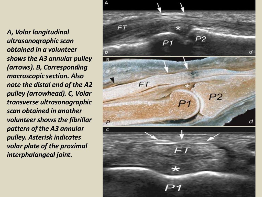 Presentation1.pptx, ultrasound of the hand and fingers.