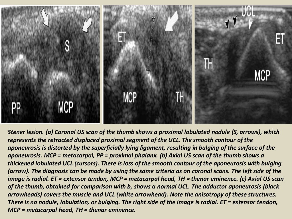 Presentation1.pptx, ultrasound of the hand and fingers.