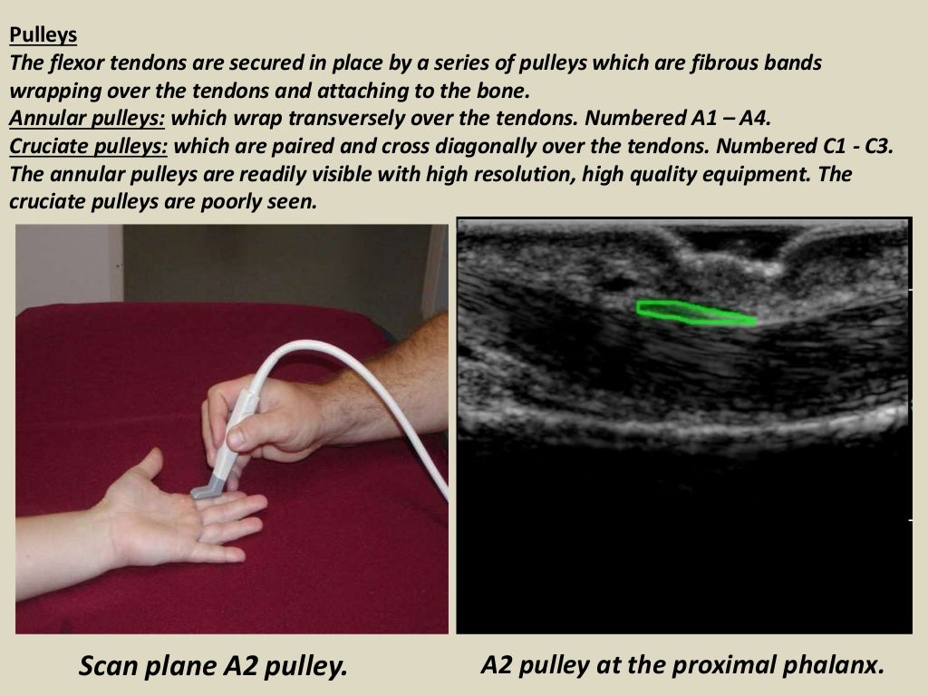 Presentation1.pptx, ultrasound of the hand and fingers.