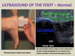 presentation1-pptx-ultrasound-examination-of-the-foot-pptx