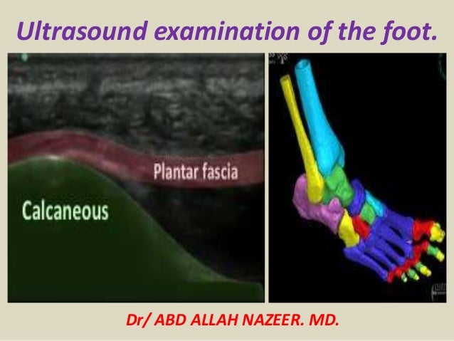 plantar fasciitis ultrasound