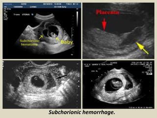 Subchorionic Infarct Presentation1.pptx, ultrasound examination of the 1st trimester ...