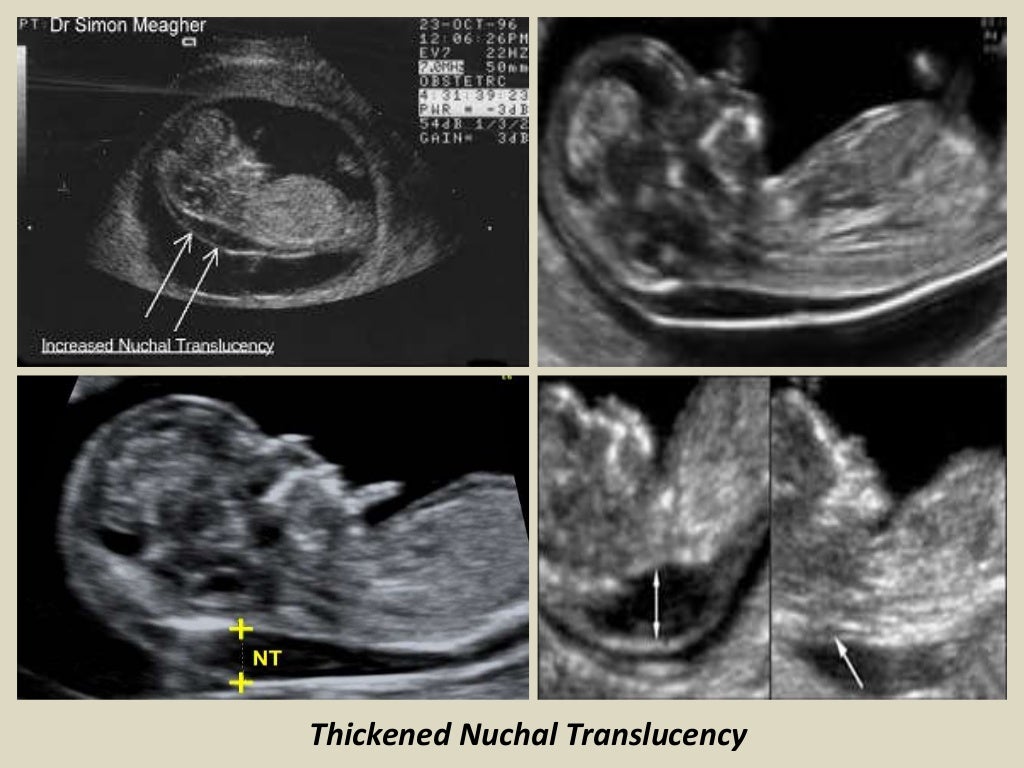 Presentation1.pptx, ultrasound examination of the 1st trimester pregn…