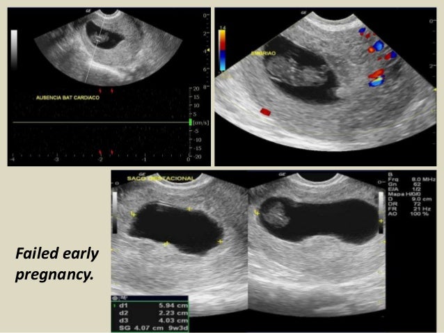 Presentation1.pptx, ultrasound examination of the 1st trimester pregn…