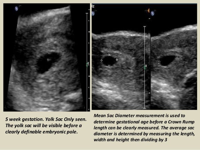 Can you have a dating scan at 7 weeks