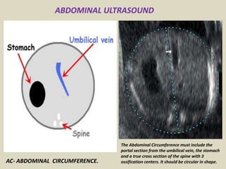 Presentation1.pptx, ultrasound examination of the 2nd & 3rd trimester ...
