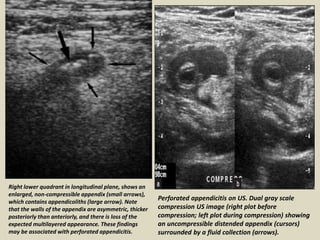 Presentation1.pptx, ultrasound examination of the appendix. | PPTX