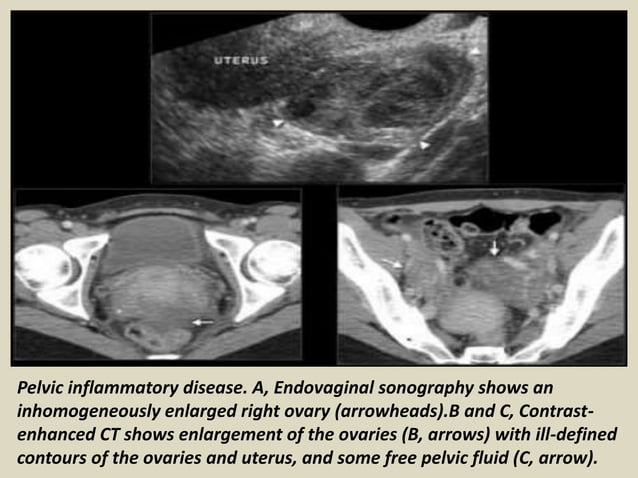 Presentation1.pptx, ultrasound examination of the appendix. | PPTX