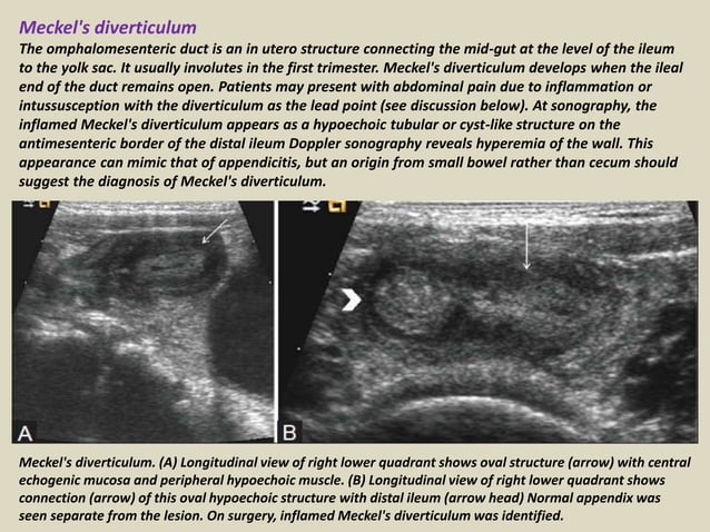 Presentation1.pptx, ultrasound examination of the appendix. | PPTX