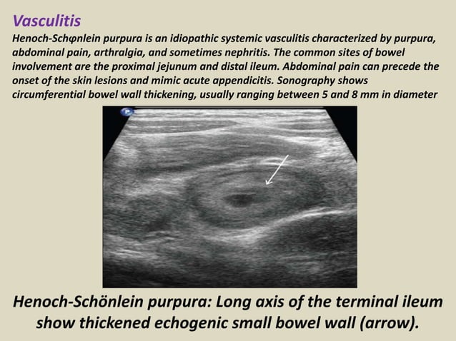 Presentation1.pptx, ultrasound examination of the appendix. | PPTX