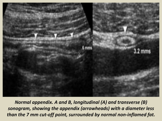 Presentation1.pptx, ultrasound examination of the appendix. | PPT