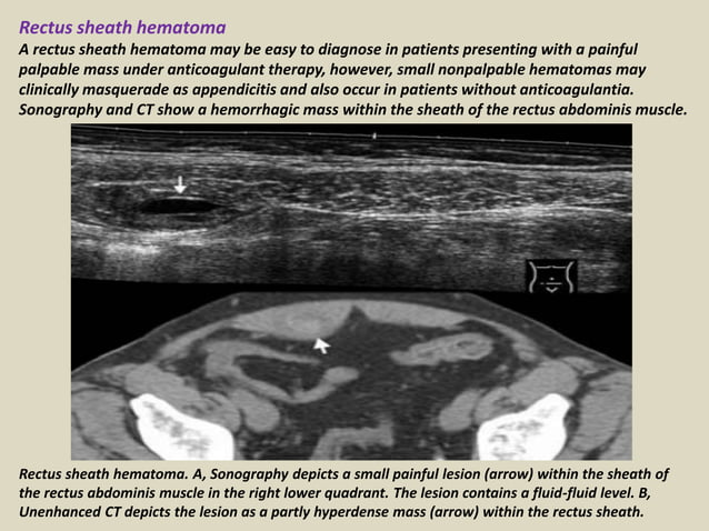 Diagnosis Of Appendicitis By Transvaginal Ultrasound Examination – CXXYLX