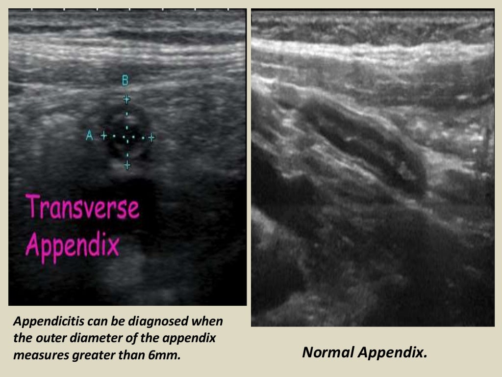 Presentation1.pptx, ultrasound examination of the appendix.