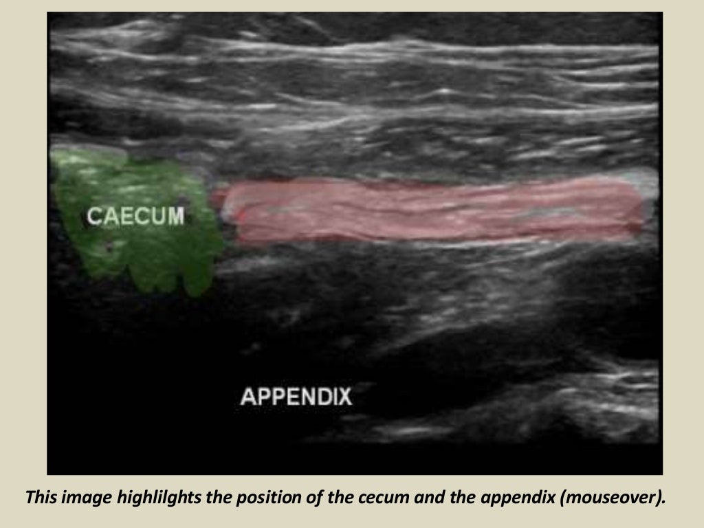 Presentation1.pptx, ultrasound examination of the appendix.