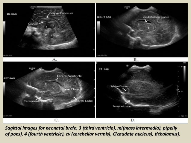 presentation1 pptx  ultrasound examination of the neonatal