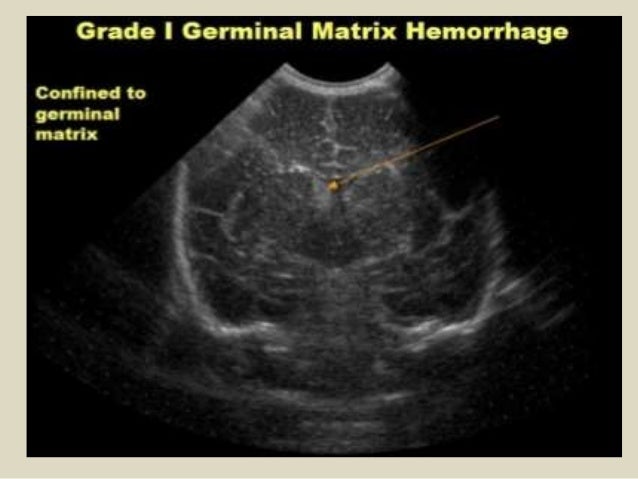 Presentation1pptx Ultrasound Examination Of The Neonatal Head