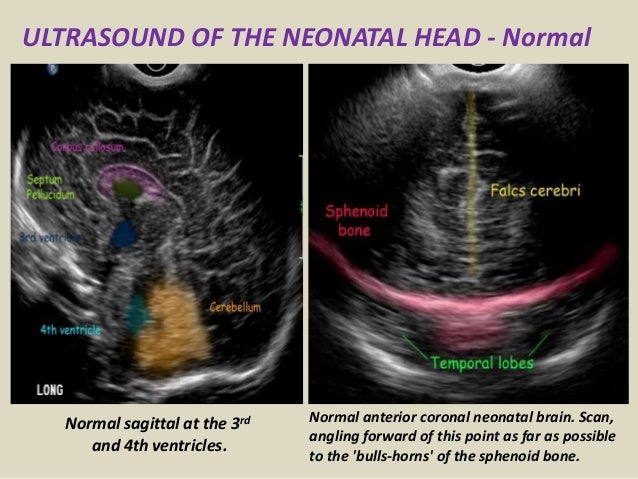 Presentation1.pptx, ultrasound examination of the neonatal head.