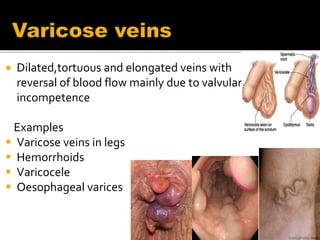  Dilated,tortuous and elongated veins with
reversal of blood flow mainly due to valvular
incompetence
Examples
 Varicose veins in legs
 Hemorrhoids
 Varicocele
 Oesophageal varices
 