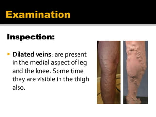 Inspection:
 Dilated veins: are present
in the medial aspect of leg
and the knee. Some time
they are visible in the thigh
also.
 