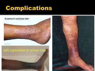 lipodermatosclerosis
Eczema in varicose vein
 