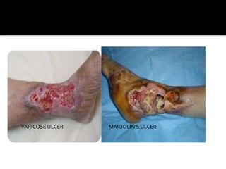 VARICOSE ULCER MARJOLIN’S ULCER
 