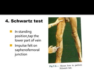 4. Schwartz test
 In standing
position,tap the
lower part of vein
 Impulse felt on
saphenofemoral
junction
 