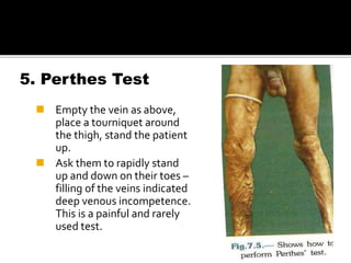 5. Perthes Test
 Empty the vein as above,
place a tourniquet around
the thigh, stand the patient
up.
 Ask them to rapidly stand
up and down on their toes –
filling of the veins indicated
deep venous incompetence.
This is a painful and rarely
used test.
 