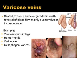 Varicose vein  [  chronic venous incompetent.pptx