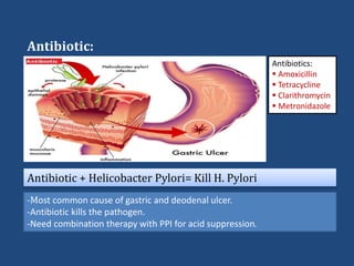 Antibiotic:
Antibiotic + Helicobacter Pylori= Kill H. Pylori
Antibiotics:
 Amoxicillin
 Tetracycline
 Clarithromycin
 Metronidazole
-Most common cause of gastric and deodenal ulcer.
-Antibiotic kills the pathogen.
-Need combination therapy with PPI for acid suppression.
 