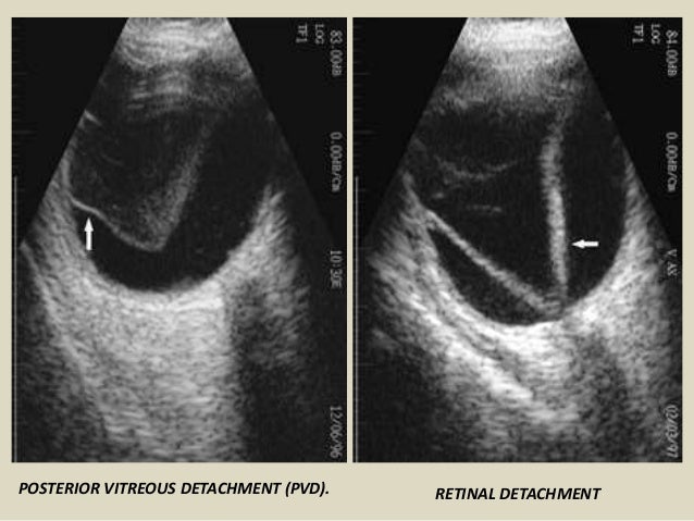 Presentation1pptx Ultrasound Examination Of The Orbit Presentation1pptx Ultrasound Examination Of The Orbit