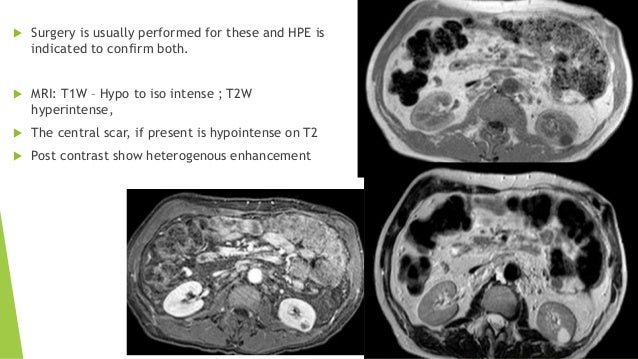 Benign Tumors Of Kidney Ureter Bladder