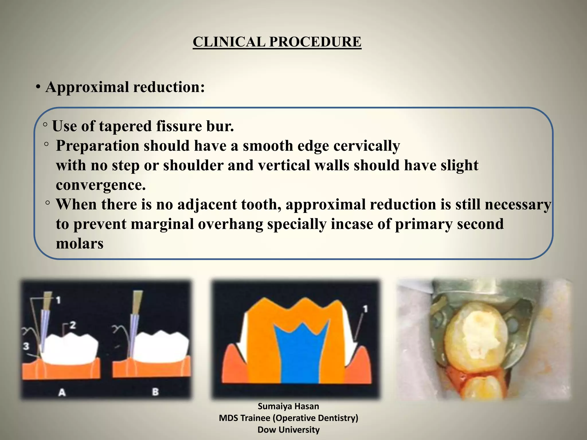 Stainless Steel Crowns In Paediatric Dentistry | PPTX