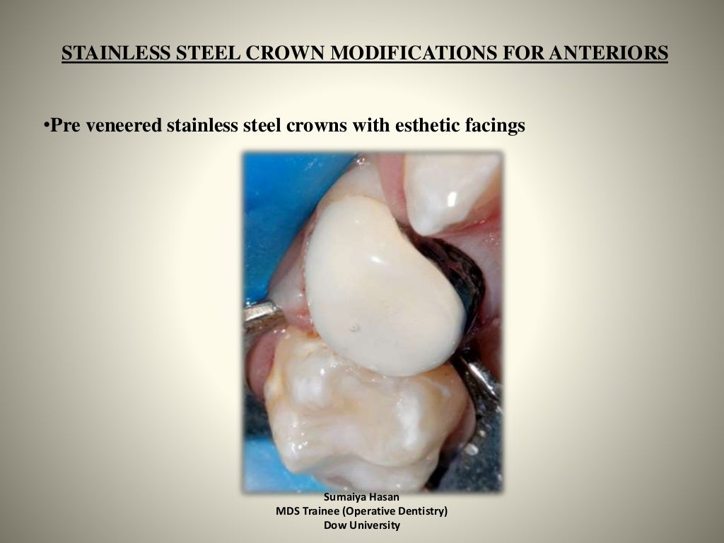 Stainless Steel Crowns In Paediatric Dentistry