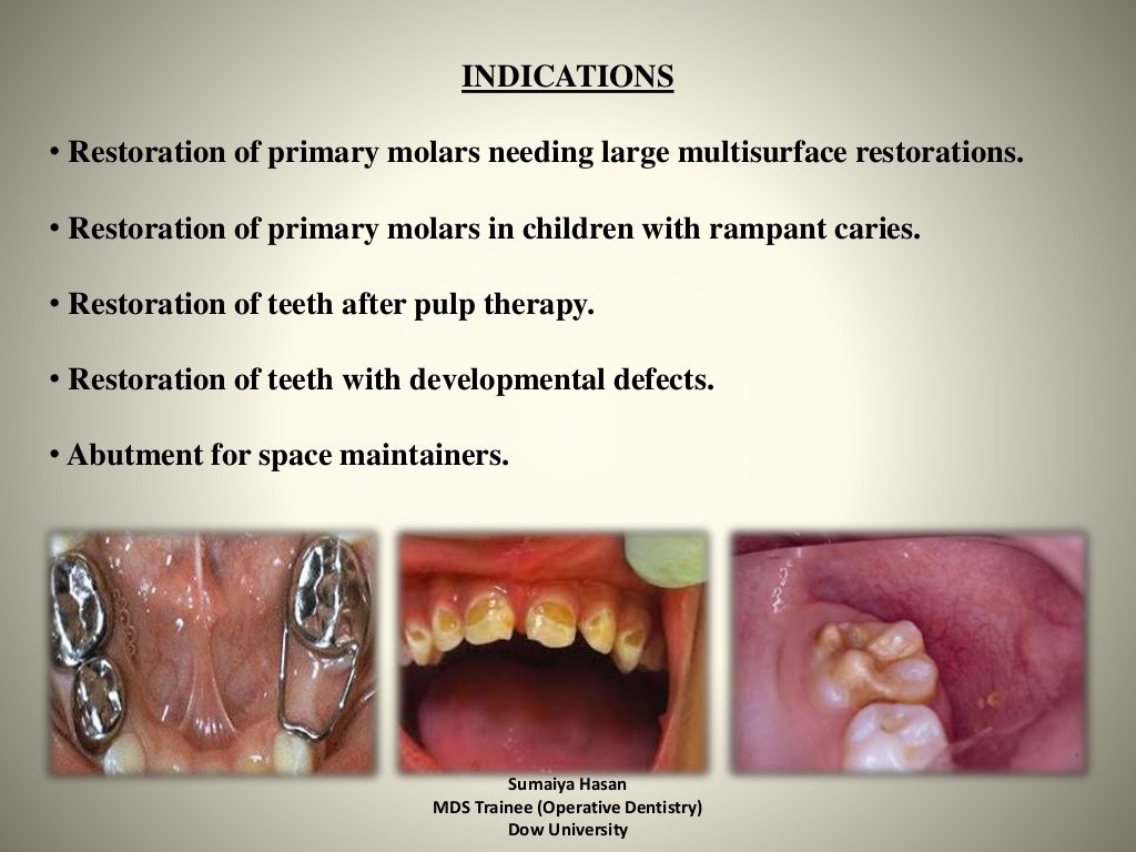 Stainless Steel Crowns In Paediatric Dentistry