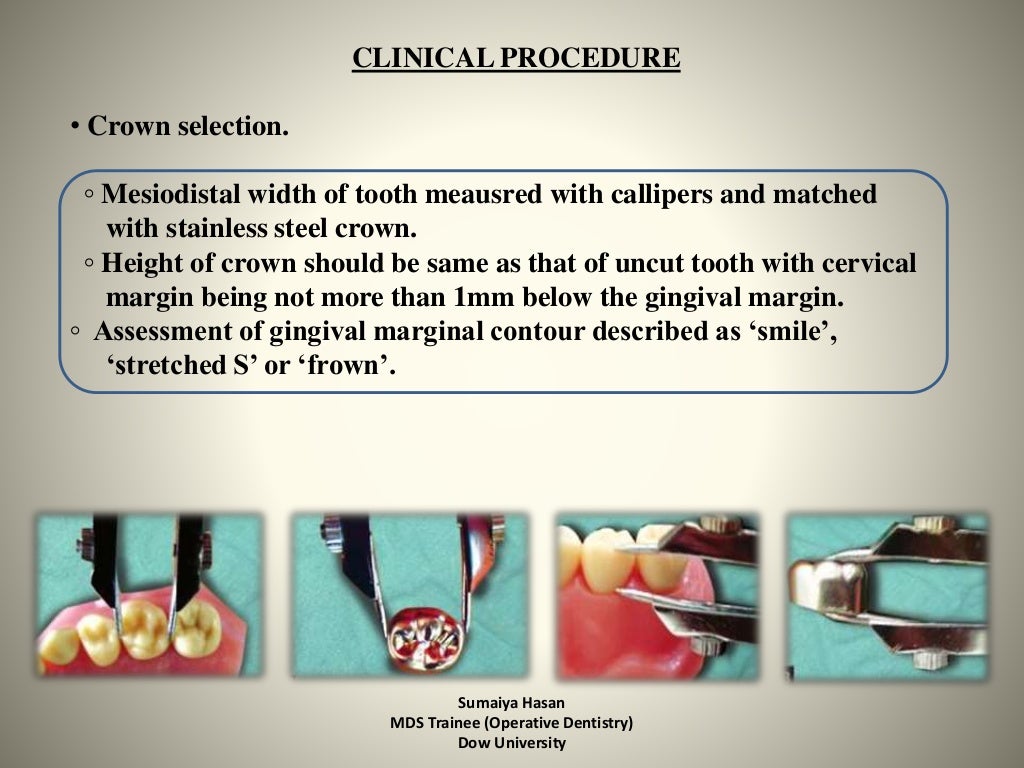 Stainless Steel Crowns In Paediatric Dentistry