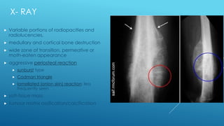 osteosarcoma | PPTX