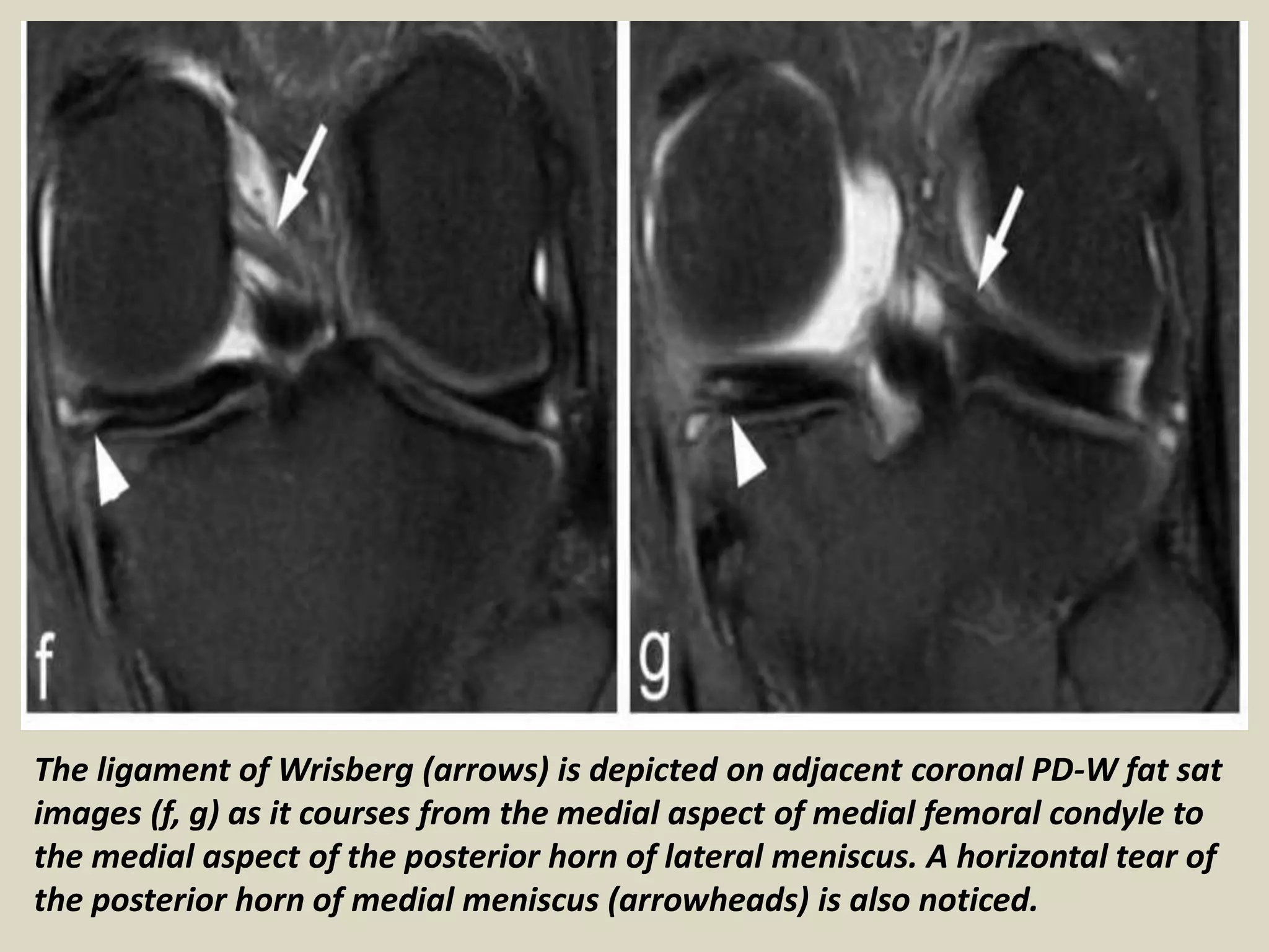 Presentation1.pptx, diagnostic pitfalls mimicking meniscal tear and ...