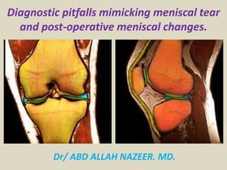 Diagnostic pitfalls mimicking meniscal tear
and post-operative meniscal changes.
Dr/ ABD ALLAH NAZEER. MD.
 