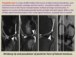 Presentation1.pptx, diagnostic pitfalls mimicking meniscal tear and ...
