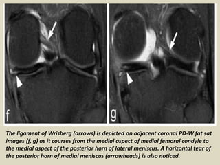 Wrisberg Rip Mri Presentation1.pptx, diagnostic pitfalls mimicking meniscal tear and ...