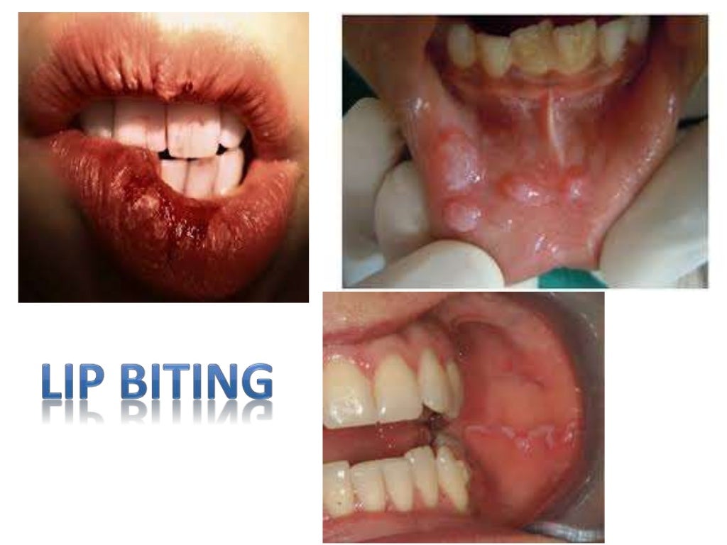 MANAGEMENT OF BRUXISM, LIP BITING AND MASOCHISTIC HABITS