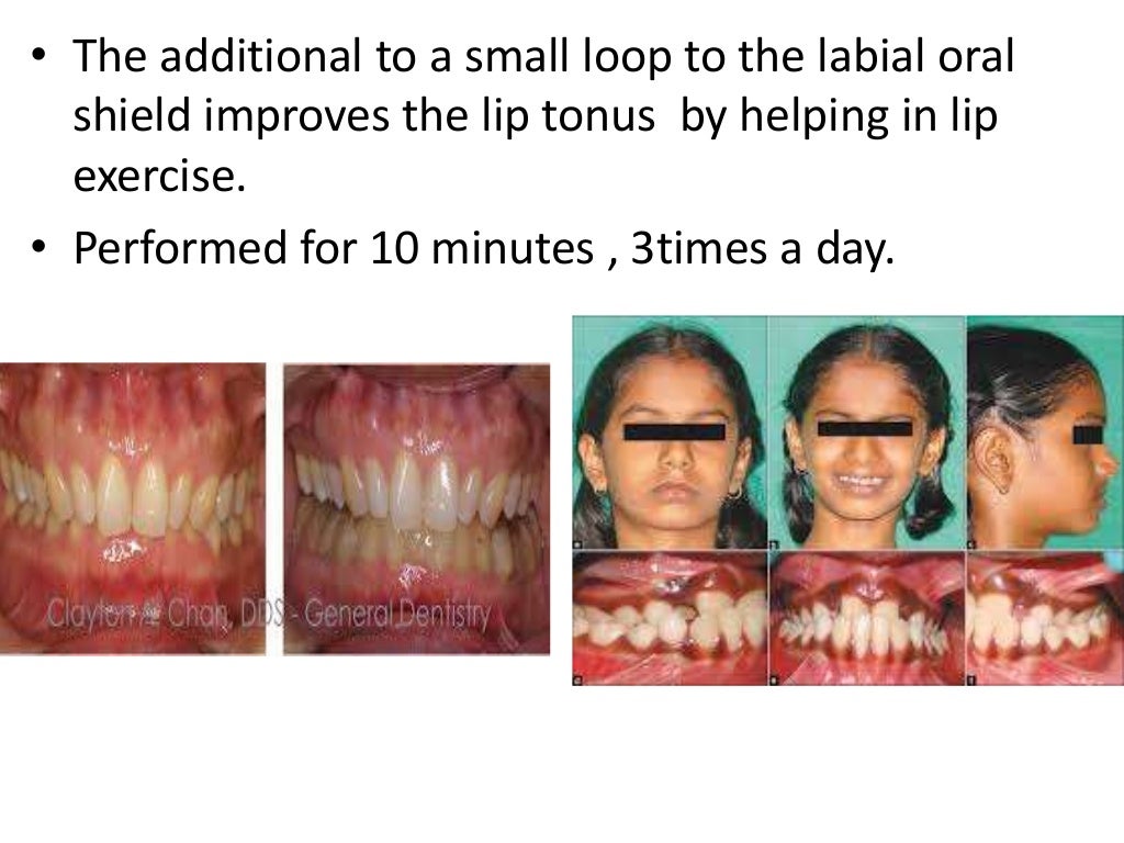 MANAGEMENT OF BRUXISM, LIP BITING AND MASOCHISTIC HABITS