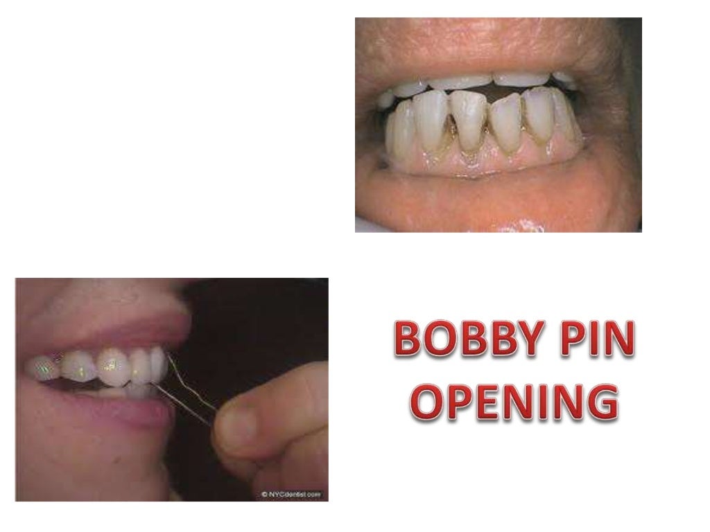 MANAGEMENT OF BRUXISM, LIP BITING AND MASOCHISTIC HABITS