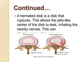 Continued…
 A herniated disk is a disk that
ruptures. This allows the jelly-like
center of the disk to leak, irritating the
nearby nerves. This can
cause sciatica or back pain.
 