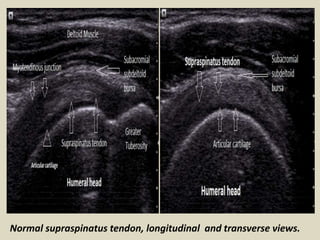 Normal supraspinatus tendon, longitudinal and transverse views.
 