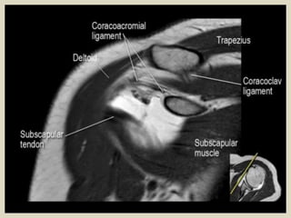 Presentation1.pptx, radiological anatomy of the shoulder joint.