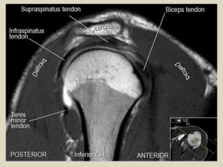 Presentation1.pptx, radiological anatomy of the shoulder joint.